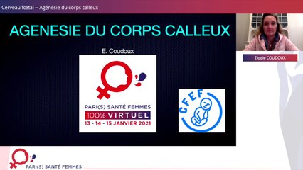 Cerveau fœtal: Agénésie du corps calleux