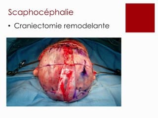 CRANIOSTÉNOSE • Traitement chirurgical