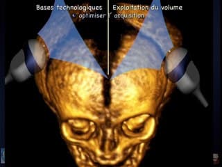 l'echographie foetal 3D en 2014