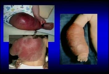 Lésions angiomateuses à révélation anténatale : diagnostic ? Que dire ? Que faire ?