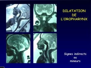 Nouvelles imageries de l'atrésie de l'oesophage