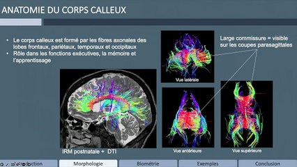 Faut-il mesurer le corps calleux ?