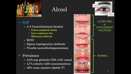 Grossesse sous toxique(s): Conséquences sur l’imagerie fœtale