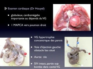 Atrésie pulmonaire à septum intact et calcifications cardiaques. Diagnostic précoce