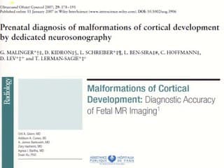Hétérotopies nodulaires prénatales