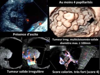 Pathologie ovarienne : du bénin au malin
