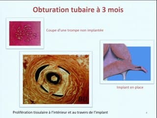 Le controle d'essure : sur quelles images s'assurer de la bonne mise en place