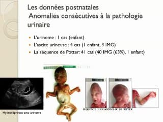 Malformatins néphro-urinaires : étude rétrospective de 98 dossiers de diagnostic prénatal.