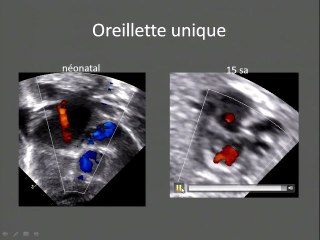 Echographie cardiaque au 1 er trimestre
