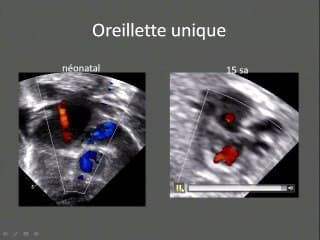 échographie cardiaque au 1 er trimestre
