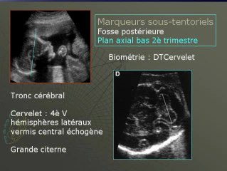 Les marqueurs échographiques du développement cérébral normal
