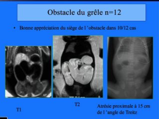 Apport de l'IRM dans la pathologie du tube digestif foetal