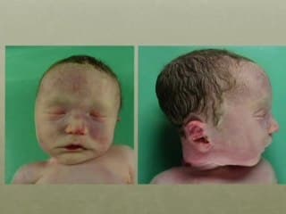 syndrome de Palister Hall