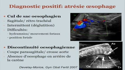 Thorax, génétique ? Atrésie de l'ésophage : dépistage, diagnostic et orientations thérapeutiques