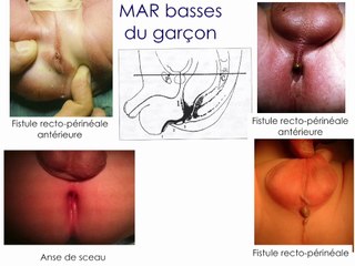 Les malformations anorectales : le plus souvent associées qu’isolées