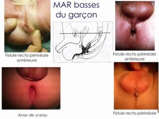 Les malformations anorectales : le plus souvent associées qu’isolées