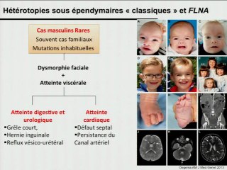 Hétérotopies nodulaires périventriculaires : identifier l'homogène dans l'hétérogène pour définir le pronostic.