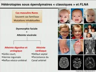 Hétérotopies nodulaires périventriculaires : identifier l'homogène dans l'hétérogène pour définir le pronostic.