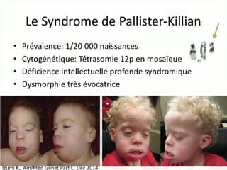 Syndrome de Pallister-Killian.