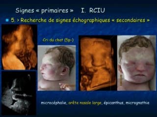 Les signes échographiques sous-estimés dans le pronostic fœtal