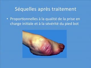 Le pied bot à l’âge adulte