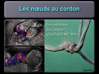 Le cordon : insertion vélamenteuse, noeuds, kystes, tumeurs