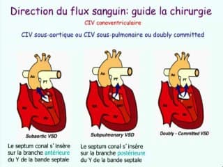 De la transposition simple à la malposition complexe des gros vaisseaux