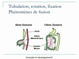 Echogéniscité digestive 1er trim