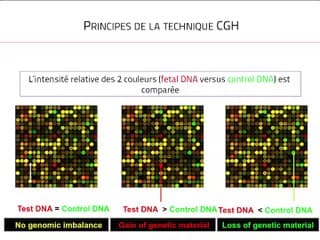 Quand faire une analyse chromosomique foetale  par analyse chromosomique par puce à ADN