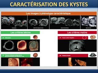 Endométriose : de l'annexe aux lésions du pelvis