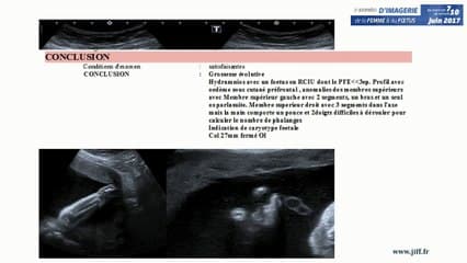 Agénésie d'une extrémité