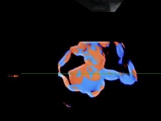 Anévrysme de Galien