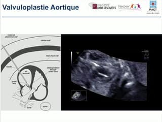 Sténose aortique : dilatation in utero