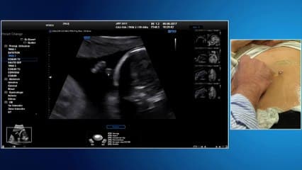 Recommandations CNEOF 2016 : les inchangés et les nouveautés ? Squelette : membres, rachis, côtes