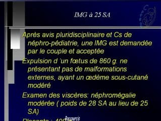 Syndrome néphrotique finlandais