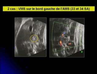 Etude préliminaire des vaisseaux mésentériques du foetus.
