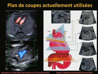 55 L’examen du cœur fœtal au 1er trimestre en mode SMI, jusqu’où peut-on aller ?
