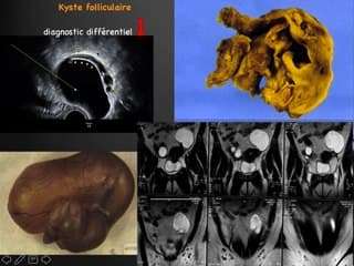 Signification échographique et conséquences des kystes ovariens chez la femme suivie en AMP