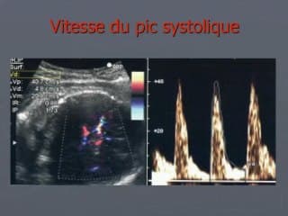 Conséquences des pathologies infectieuses sur l’abdomen et le thorax foetal