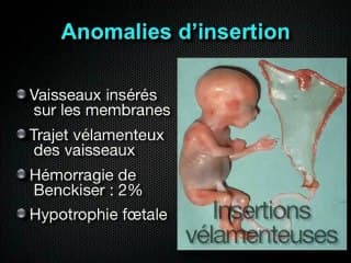 Le cordon ombilical – Insertion vélamenteuse (noeud, kyste, tumeur)