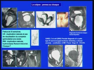 Insuffisances, incertitudes, difficultés, piéges et erreurs de l'imagerie anténatale L'abdomen.