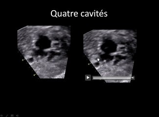 exemples d' ILVAV