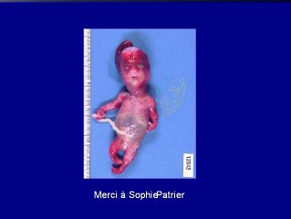 Nanisme diastrophique