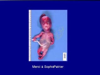 Nanisme diastrophique