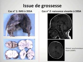 Thrombose du torcular, une évaluation pronostique difficile