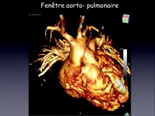 Fenetre aorto pulmonaire