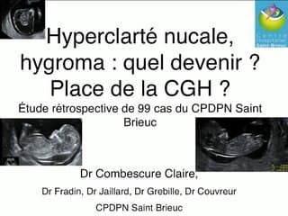 Hyperclarté nucale, hygroma : quel devenir ? Place de la CGH ? Étude rétrospective de 99 cas.