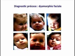 Obésité et diagnostic anténatal : Syndromes génétiques et obésité : un dépistage anténatal est-il possible ?