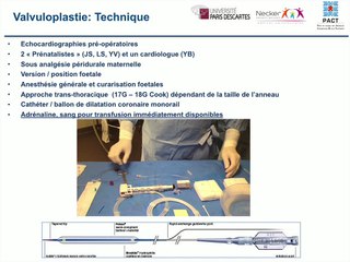 Prise en charge prénatale des sténoses aortiques et pulmonaires critiques