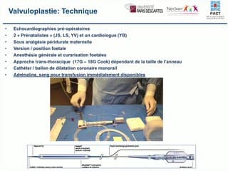 Prise en charge prénatale des sténoses aortiques et pulmonaires critiques